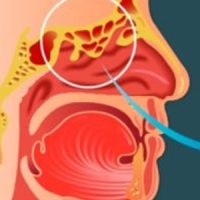 Dr-Marcos-Goncalves-rinite-alergica